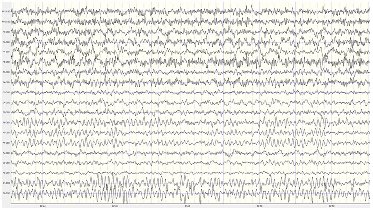 Laplacian montage EEG showing frontal and temporal EMG artifact